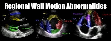 what is rwma in cardiology